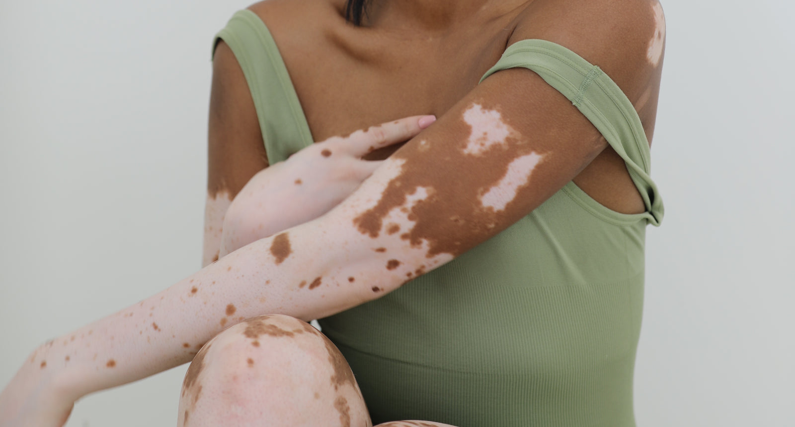 What is Vitiligo?