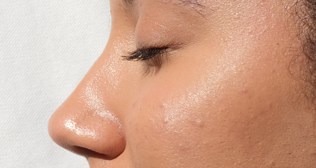 Holistic Hacks for Puffiness