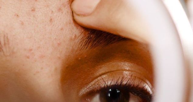 The Truth About Hormonal Acne