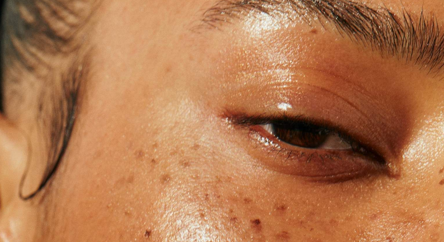 WHAT YOU SHOULD KNOW ABOUT HYPERPIGMENTATION
